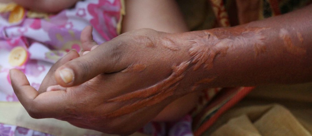 Eine von Salzsäure verätzte Hand.